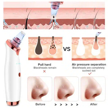 Premium Vacuum Blackhead Remover